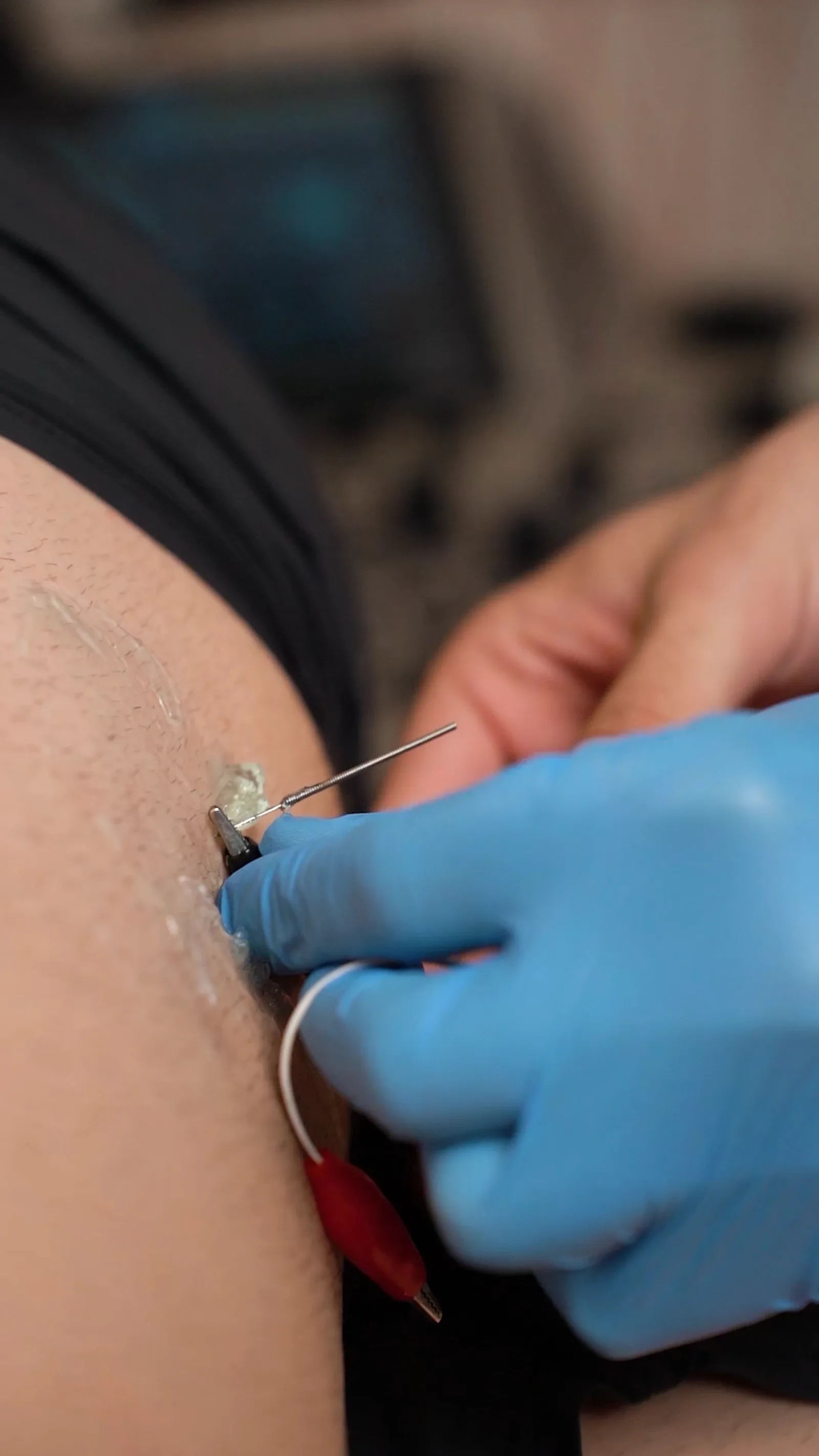 Neuromodulación con control ecográfico en Élite Fisioterapia Zaragoza